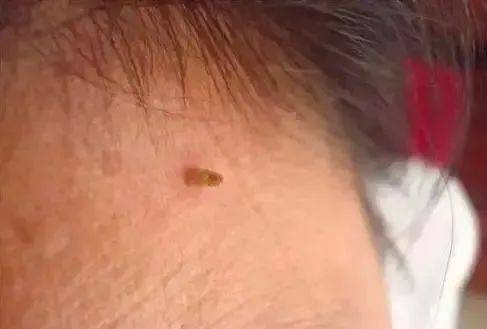 皇冠信用網在哪里开通_脖子上长出的小肉粒皇冠信用網在哪里开通，能揪吗？