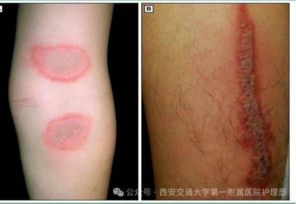 皇冠信用盘_西安多区发现隐翅虫？千万别拍皇冠信用盘！毒液堪比硫酸